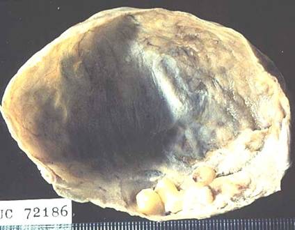 Fig.3 Cistadenofibroma del ovario fijado - <div style=